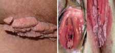 Penyebab Kutil Di Bibir Vagina
