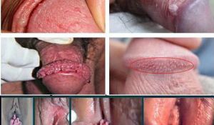 Pengobatan Kutil Kelamin Pria Wanita Pengobatan Kutil Kelamin Pria Wanita